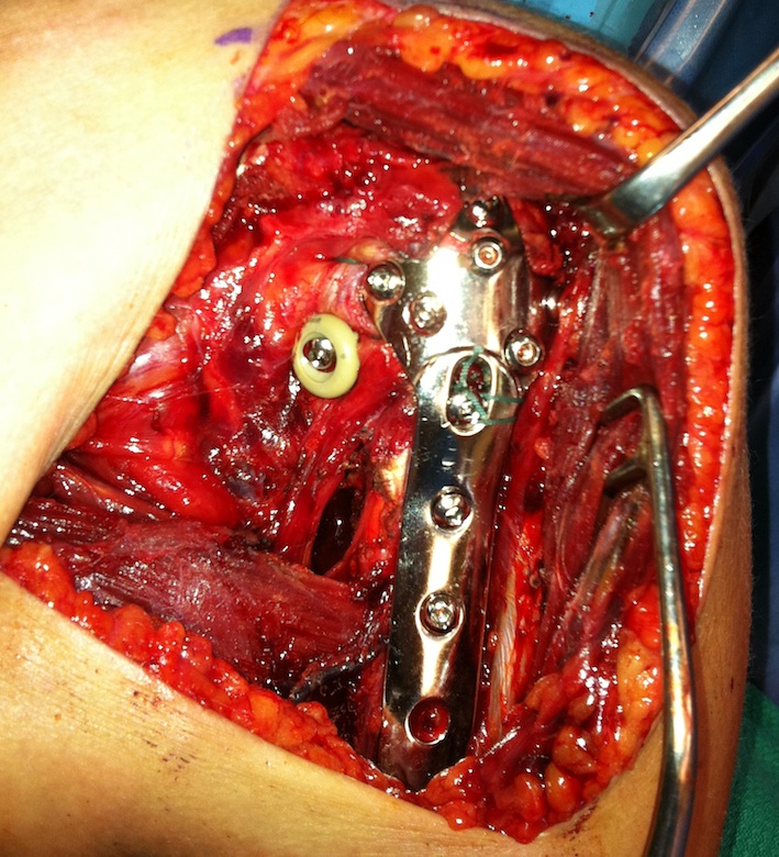 ORIF Proximal Humerus and LT ORIF